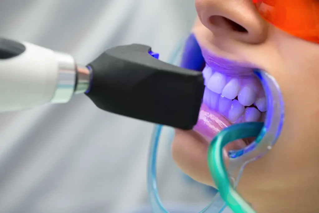 Will I See Immediate Results from Lazer Teeth Whitening Kings-Norton