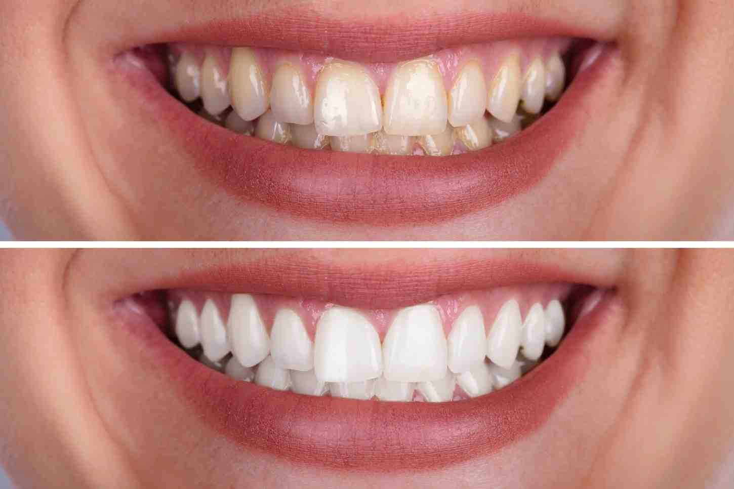 Can Teeth Whitening Fix Uneven Colour — Or Will It Just Make It Worse Kings-Norton