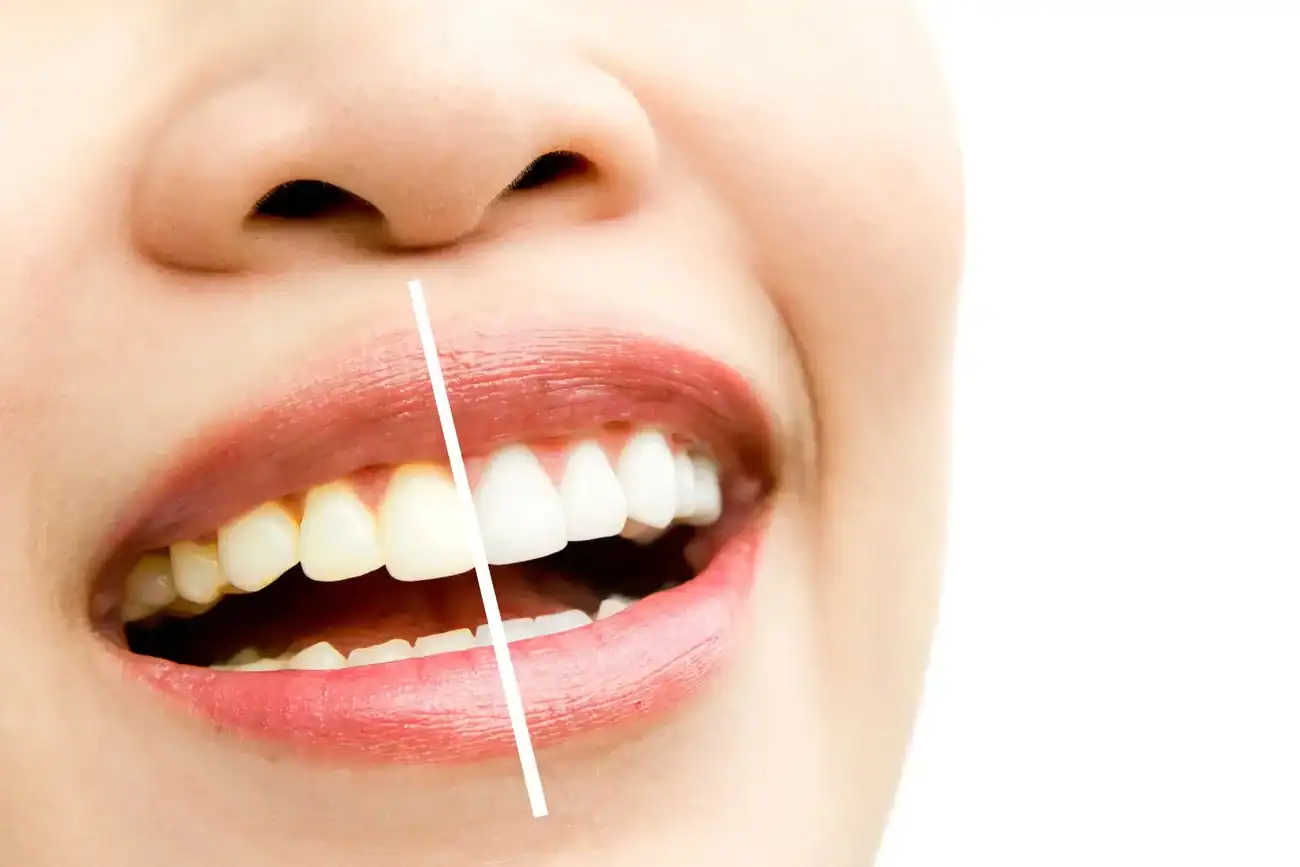 How Can I Protect My Teeth Before and After Whitening with Enamel Loss Kings-Norton